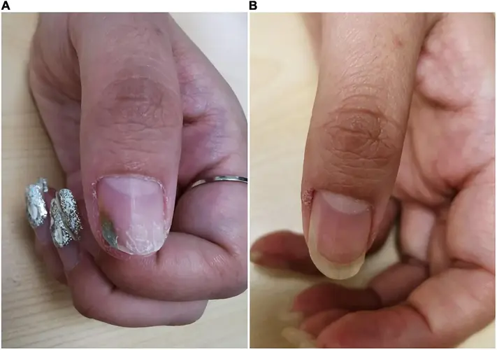 Acid-based nailpenetrating agents