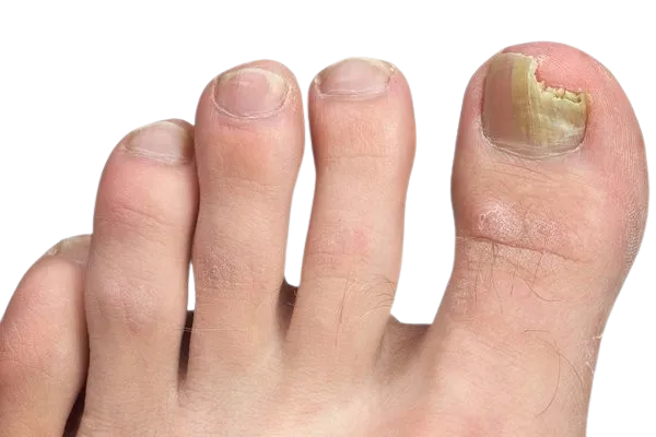 Nail Fungus Treatments