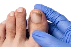 Nail Hygiene Fungal nail infections, conceal + treat